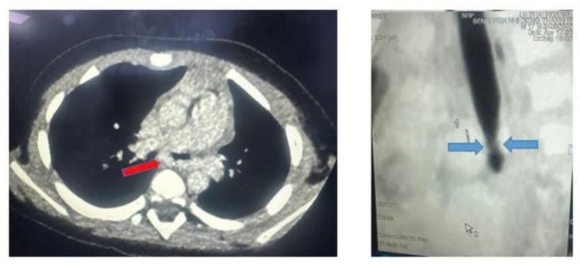 Kết quả CT - scan ngực cho thấy động mạch phổi trái quấn hẹp khí quản gốc, mặt cắt dọc đứng thấy hẹp khí quản gốc (carina). Ảnh: Sức Khỏe & Đời Sống